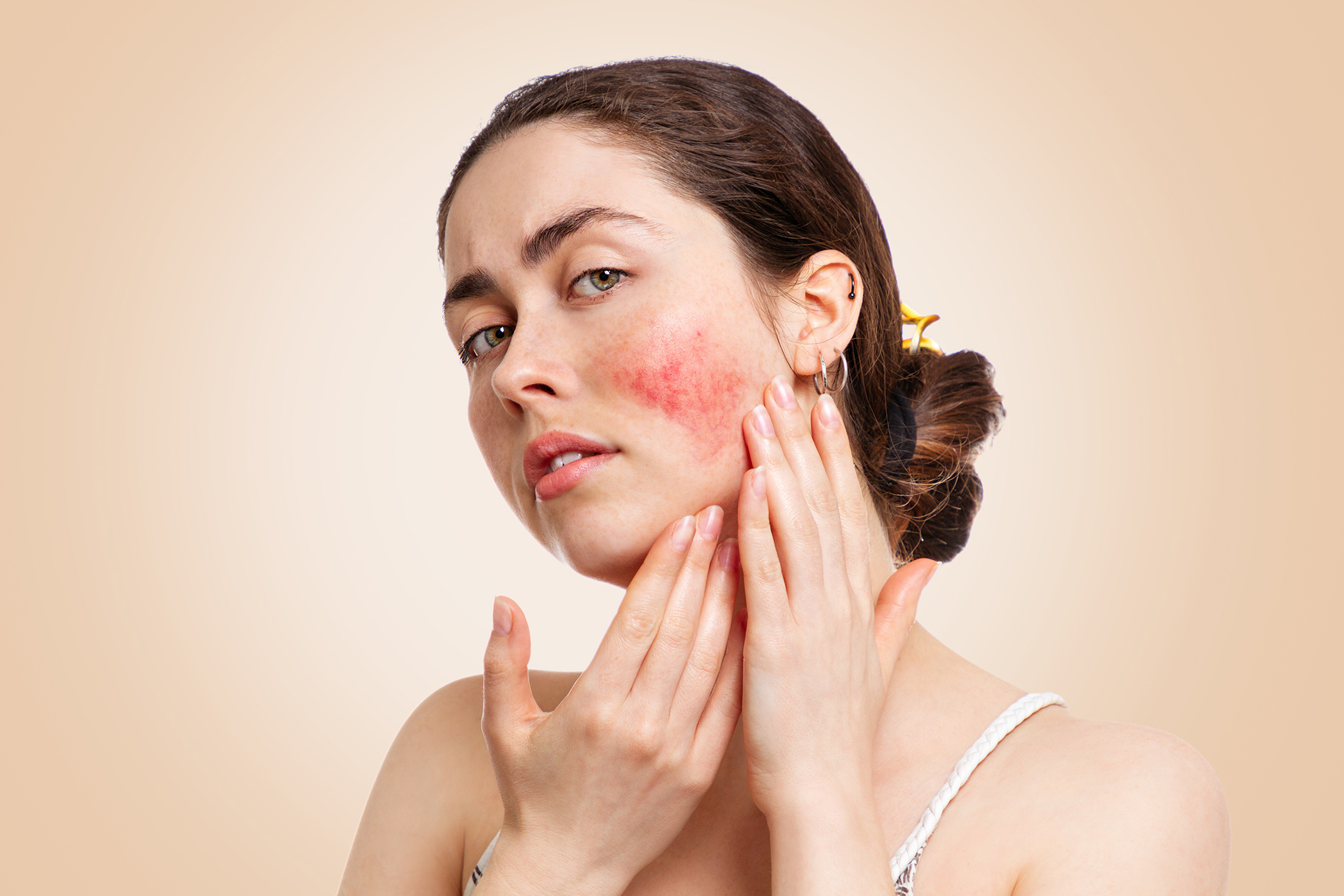 Woman with Rosacea